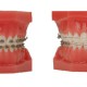 歯列矯正に使う器具や矯正期間に関して